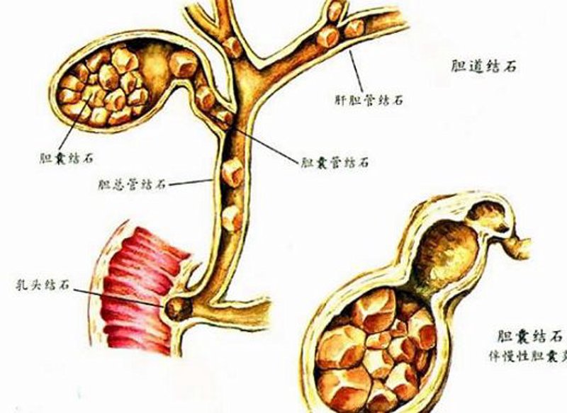 保胆取石手术后的注意事项与日常维护指南