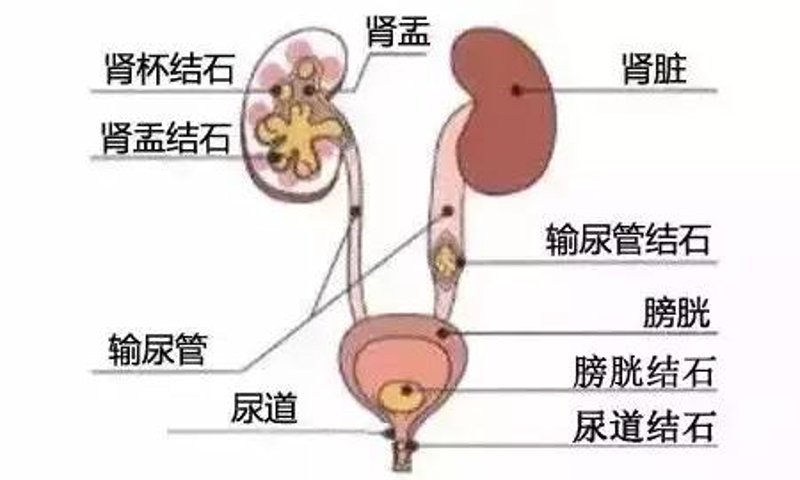 胆结石手术选择指南：帮助您轻松应对