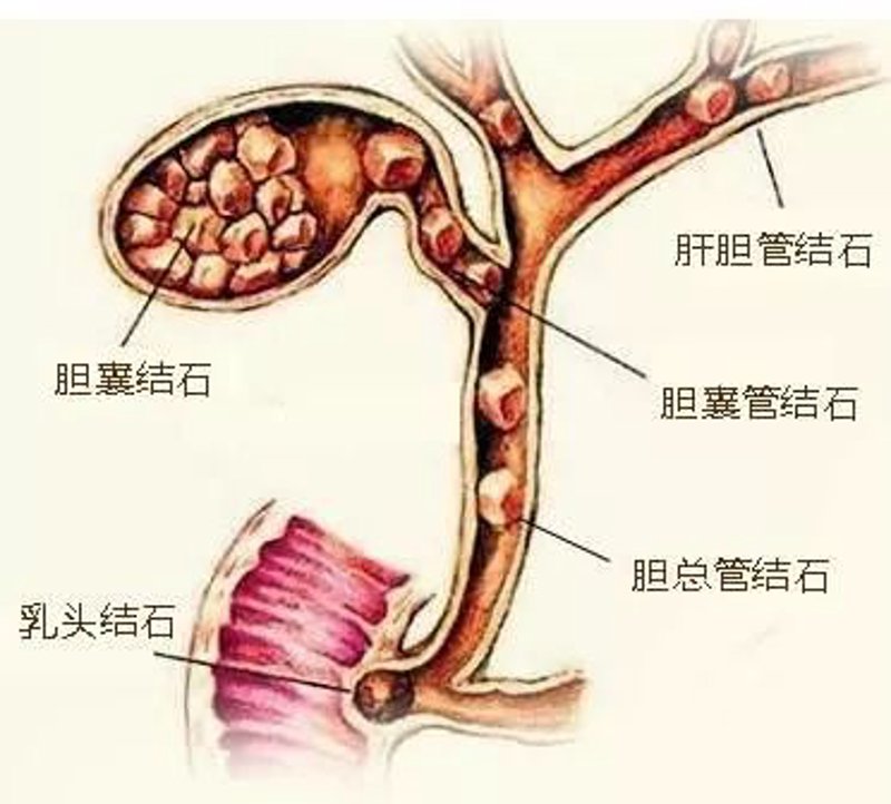 胆结石手术：避开这些常见误区，安全有效