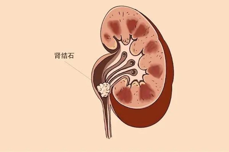 结石病困扰？重庆结石病医院的治愈之路
