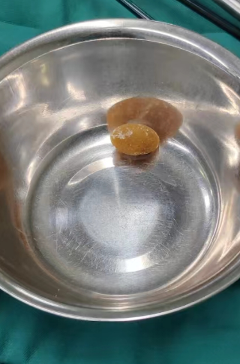 重庆结石病医院