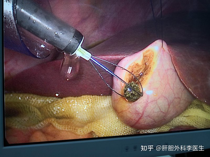 胆结石手术