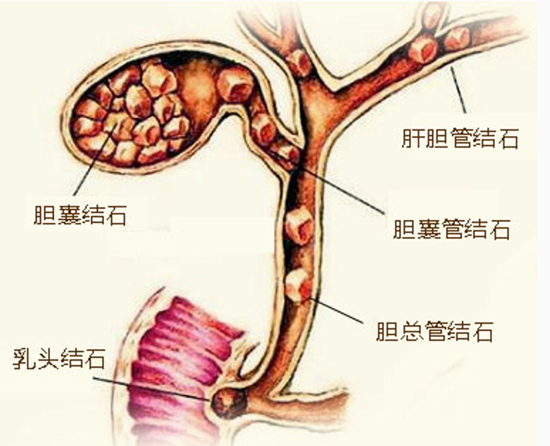 从案例看‘保肾取石’的正确打开方式