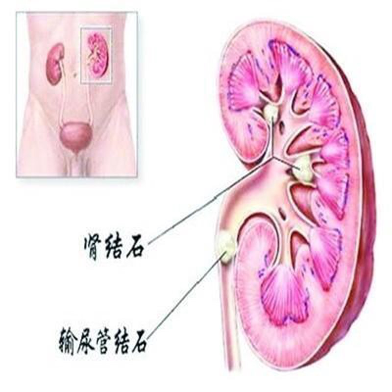 有效缓解胆结石困扰的三大手术技巧